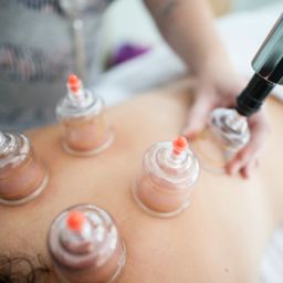 Photo of a cupping procedure