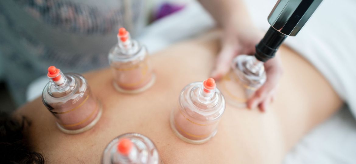 Photo of a cupping procedure